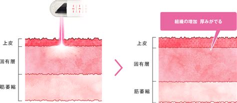 感度アップ|Gショット（感度UP手術）